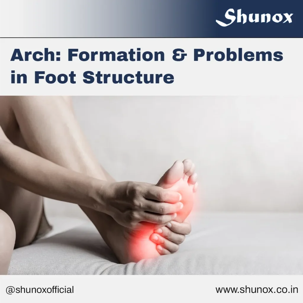 Flat Foot & Arch Formation problems