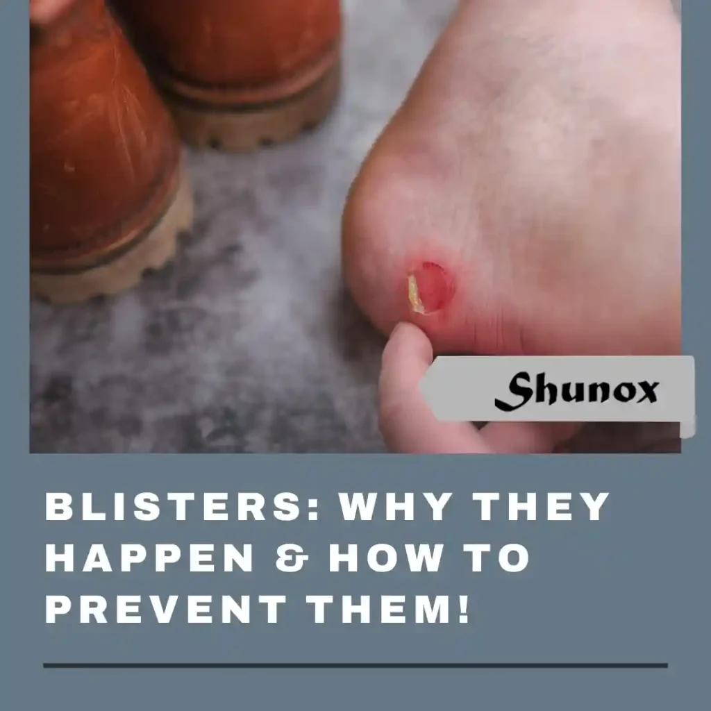 Blisters- Cause & prevention​
