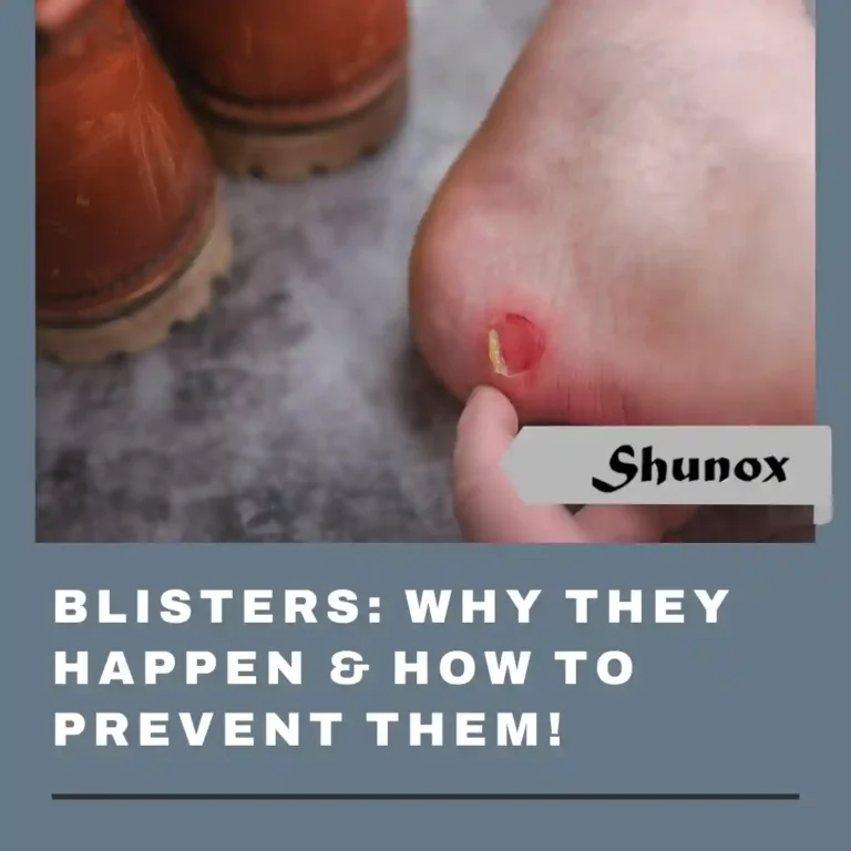 Blisters- Cause & prevention​